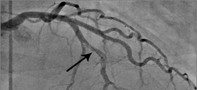 Обзорная статья, систематизирующая современные представления об ОКС на фоне спонтанной диссекции коронарных артерий (СДКА)